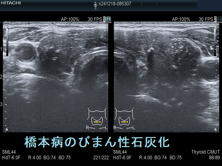 橋本病のびまん性石灰化 超音波(エコー)画像 全体像 橋本病のびまん性石灰化 超音波(エコー)画像 全体像