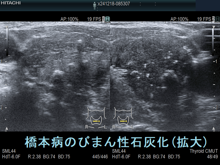 橋本病のびまん性石灰化 超音波(エコー)画像(拡大) 橋本病のびまん性石灰化 超音波(エコー)画像(拡大)