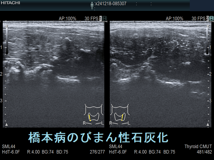橋本病のびまん性石灰化 超音波(エコー)画像(縦断) 橋本病のびまん性石灰化 超音波(エコー)画像(縦断)