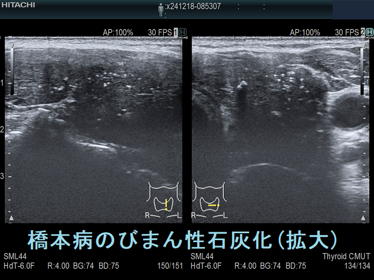 橋本病のびまん性石灰化 左葉 超音波(エコー)画像(拡大) 橋本病のびまん性石灰化 左葉 超音波(エコー)画像(拡大)
