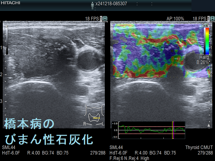 橋本病のびまん性石灰化 左葉 超音波(エコー)画像 エラストグラフィー 橋本病のびまん性石灰化 左葉 超音波(エコー)画像 エラストグラフィー