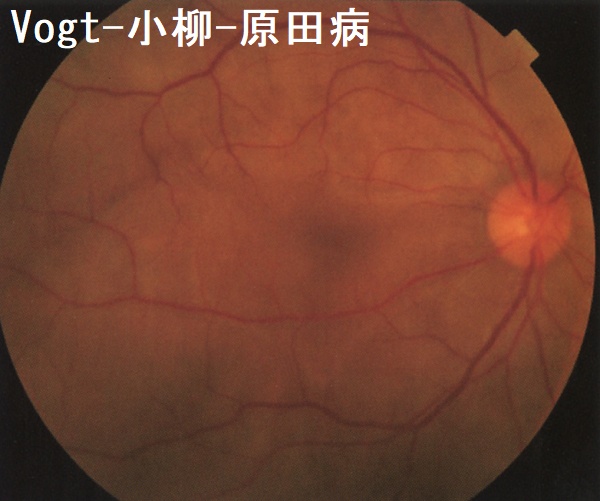 Vogt-小柳-原田病 眼底写真 Vogt-小柳-原田病 眼底写真