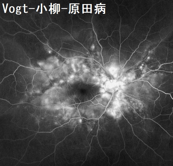 Vogt-小柳-原田病 蛍光眼底造影写真 Vogt-小柳-原田病 蛍光眼底造影写真