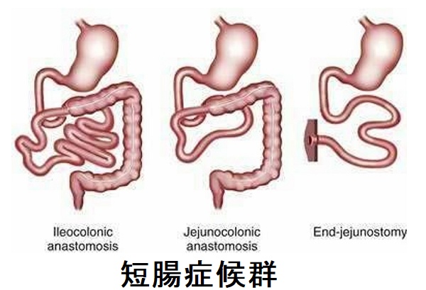 短腸症候群 短腸症候群
