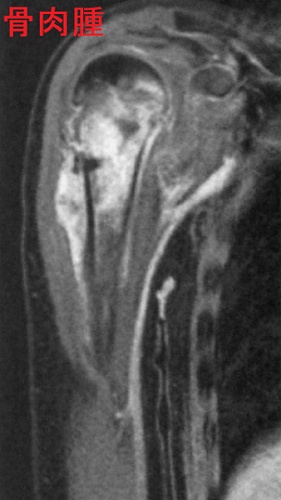 骨肉腫 右上腕骨MRI 脂肪抑制造影T1 強調冠状断像 骨肉腫 右上腕骨MRI 脂肪抑制造影T1 強調冠状断像
