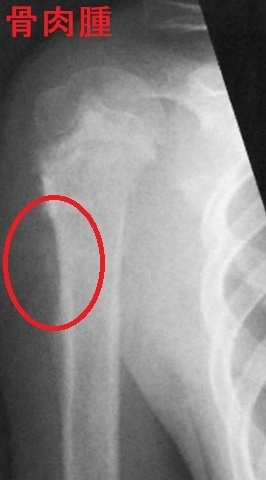 骨肉腫 右上腕骨単純エックス線写真 骨肉腫 右上腕骨単純エックス線写真