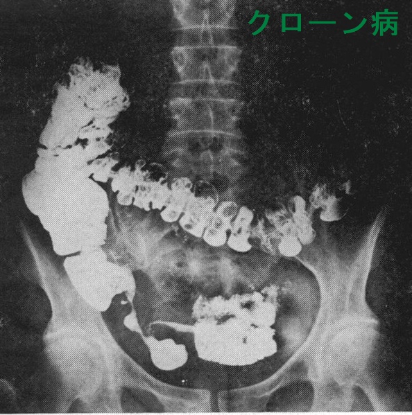クローン病 注腸検査 クローン病 注腸検査