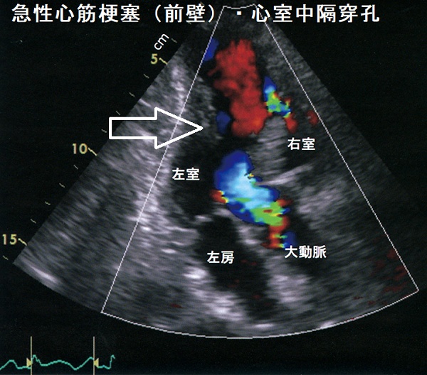 急性心筋梗塞(前壁)・心室中隔穿孔 心エコー図 急性心筋梗塞(前壁)・心室中隔穿孔 心エコー図