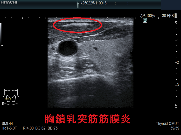 胸鎖乳突筋筋膜炎 胸鎖乳突筋筋膜炎