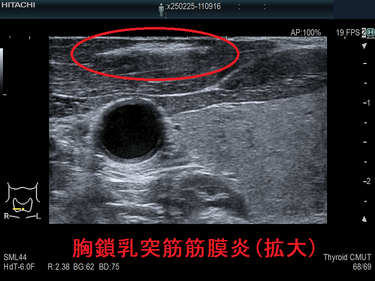 胸鎖乳突筋筋膜炎(拡大) 胸鎖乳突筋筋膜炎(拡大)