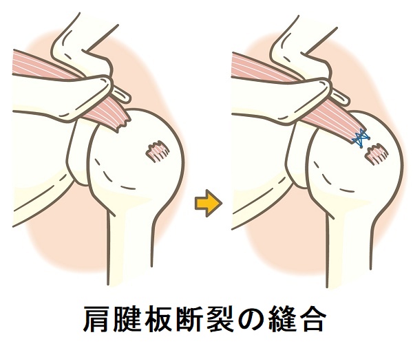 肩腱板断裂の縫合 肩腱板断裂の縫合