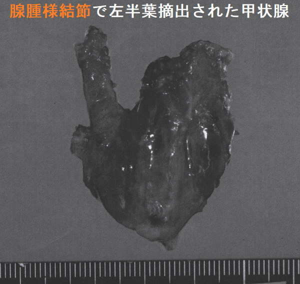 癌と確定できない、癌でない甲状腺腫瘍の手術適応[橋本病 癌と確定できない、癌でない甲状腺腫瘍の手術適応[橋本病
