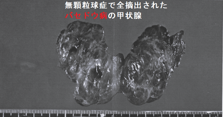 無顆粒球症で全摘出されたバセドウ病の甲状腺 無顆粒球症で全摘出されたバセドウ病の甲状腺