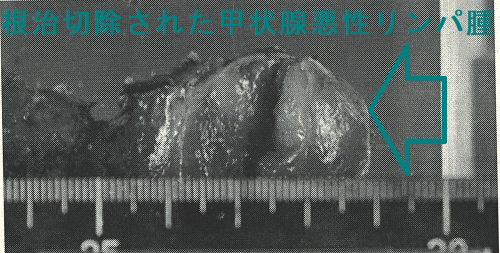 根治切除された甲状腺悪性リンパ腫2 根治切除された甲状腺悪性リンパ腫2