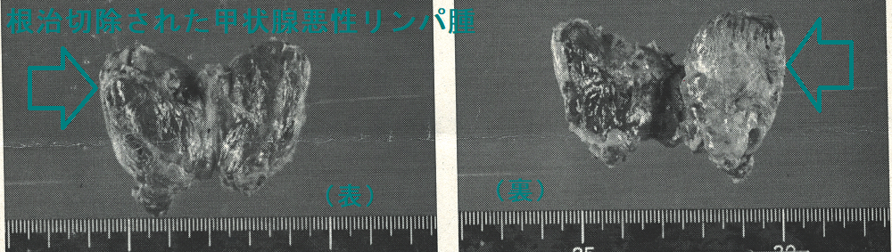 根治切除された甲状腺悪性リンパ腫1 根治切除された甲状腺悪性リンパ腫1