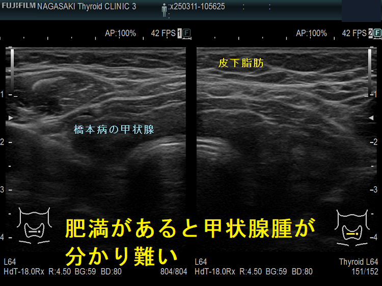 肥満があると甲状腺腫が分かり難い 肥満があると甲状腺腫が分かり難い