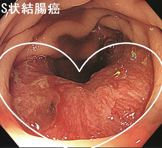 S状結腸(下部消化管内視鏡) S状結腸(下部消化管内視鏡)