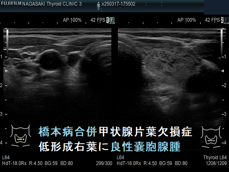 橋本病合併甲状腺片葉欠損症 低形成右葉に良性嚢胞腺腫 橋本病合併甲状腺片葉欠損症 低形成右葉に良性嚢胞腺腫