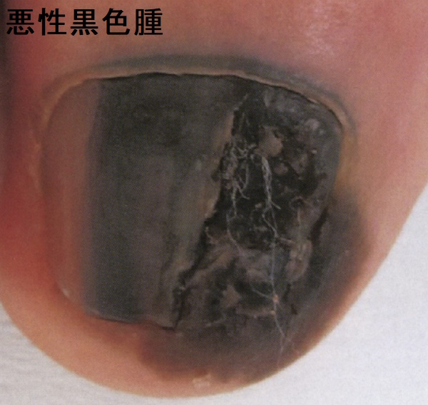 爪の悪性黒色腫 爪の悪性黒色腫