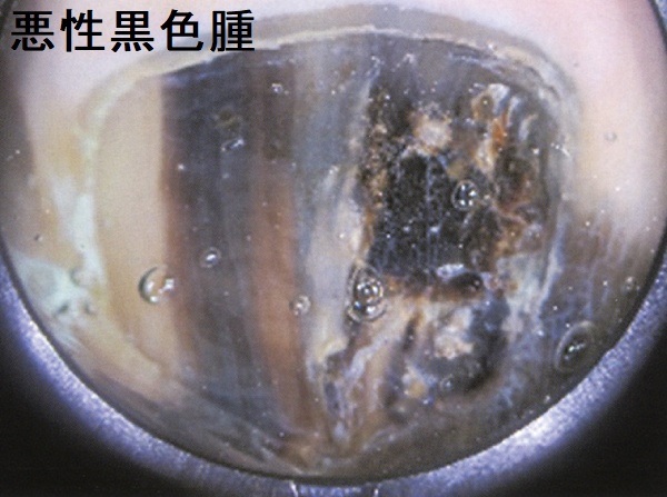 爪の悪性黒色腫 ダーモスコピー像 爪の悪性黒色腫 ダーモスコピー像