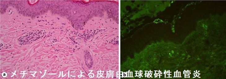 メチマゾールによる皮膚白血球破砕性血管炎 組織像 メチマゾールによる皮膚白血球破砕性血管炎 組織像