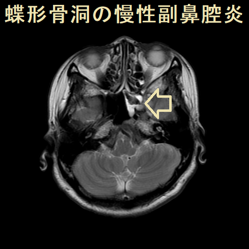 蝶形骨洞の副鼻腔炎 蝶形骨洞の副鼻腔炎