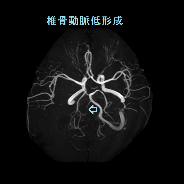 椎骨動脈低形成 椎骨動脈低形成