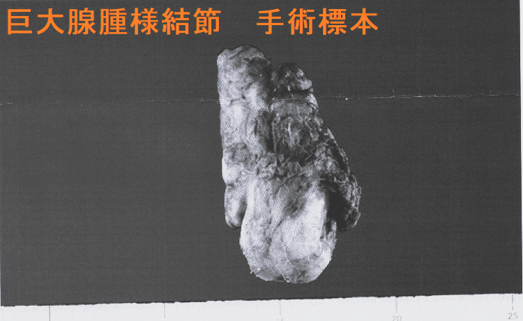 巨大腺腫様結節 手術標本1 巨大腺腫様結節 手術標本1-1