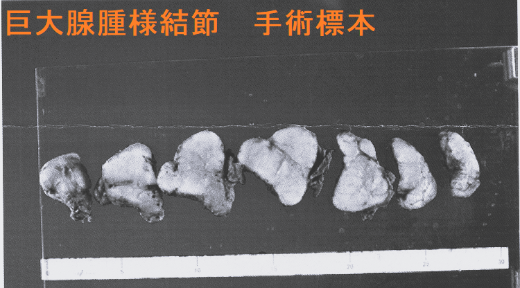 巨大腺腫様結節 手術標本2 巨大腺腫様結節 手術標本2-1