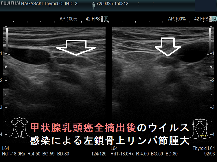 甲状腺乳頭癌全摘出後のウイルス感染による左鎖骨上リンパ節腫大 甲状腺乳頭癌全摘出後のウイルス感染による左鎖骨上リンパ節腫大