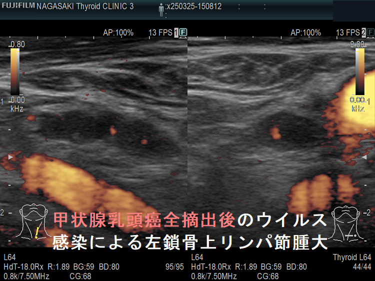 甲状腺乳頭癌全摘出後のウイルス感染による左鎖骨上リンパ節腫大(拡大) ドプラーモード 甲状腺乳頭癌全摘出後のウイルス感染による左鎖骨上リンパ節腫大(拡大) ドプラーモード
