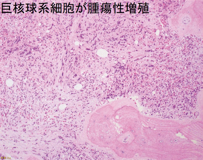 巨核球系細胞が腫瘍性増殖 巨核球系細胞が腫瘍性増殖