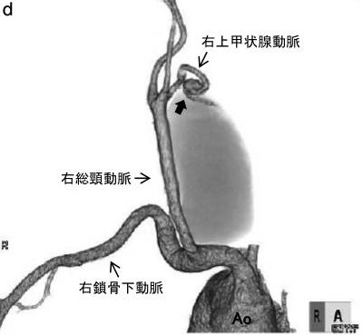 上甲状腺動脈瘤 3D-CT画像 上甲状腺動脈瘤 3D-CT画像