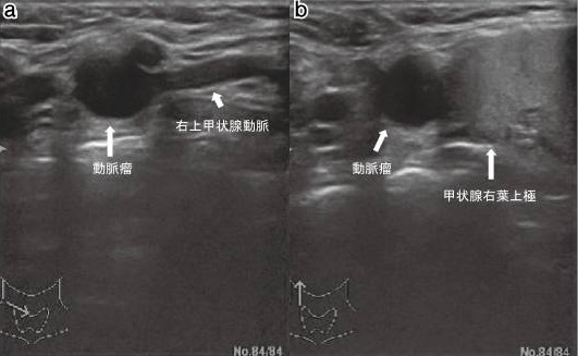上甲状腺動脈瘤 超音波(エコー)画像 上甲状腺動脈瘤 超音波(エコー)画像