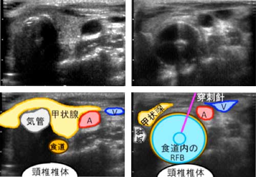 経皮経食道胃管挿入術(PTEG) 経皮経食道胃管挿入術(PTEG)
