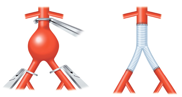 腹部大動脈瘤 人工血管置換術 腹部大動脈瘤 人工血管置換術