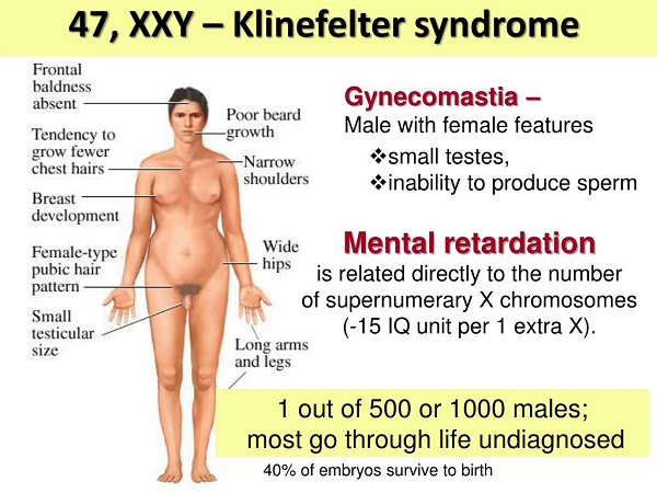 クラインフェルター症候群 クラインフェルター症候群