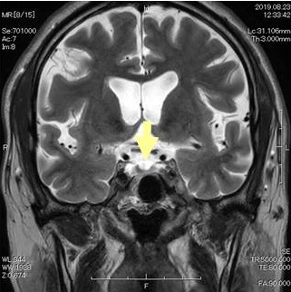 エンプティ・セラ症候群 MRI 画像 エンプティ・セラ症候群 MRI 画像