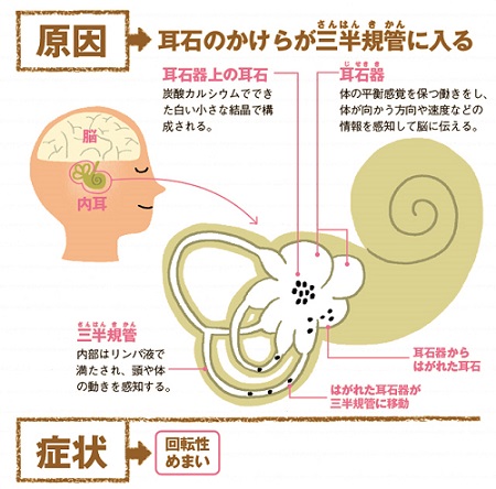 良性発作性頭位めまい症 良性発作性頭位めまい症