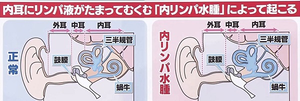メニエール病 メニエール病
