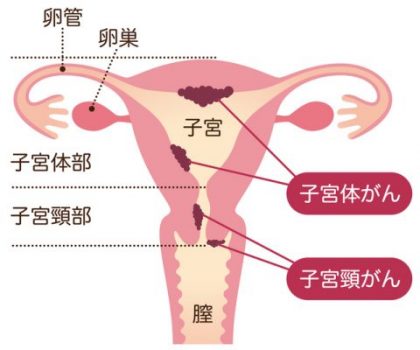 子宮体癌 106A47 | 子宮体癌 国試 | テコプラ