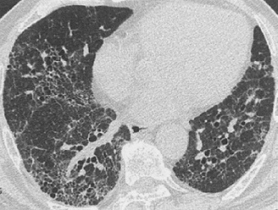 特発性肺線維症 胸部CT 特発性肺線維症 胸部CT