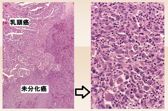 乳頭がんと未分化がんの混在 乳頭がんと未分化がんの混在