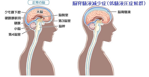 脳脊髄液減少症(低髄液圧症候群) 脳脊髄液減少症(低髄液圧症候群)MedicalNoteより