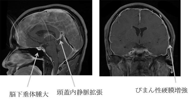 脳脊髄液減少症(低髄液圧症候群)造影MRI画像 脳脊髄液減少症(低髄液圧症候群)造影MRI画像