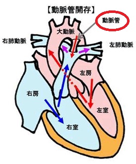 動脈管開存症 動脈管開存症