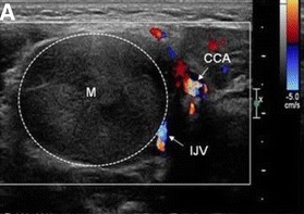 頚部神経線維腫 超音波(エコー)画像 頚部神経線維腫 超音波(エコー)画像