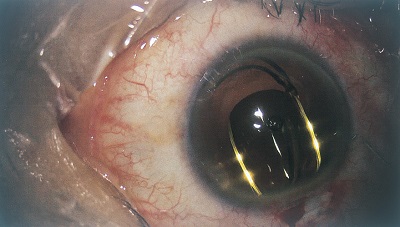 白内障 眼内レンズ挿入 白内障 眼内レンズ挿入