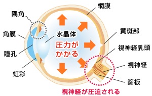 緑内障 緑内障