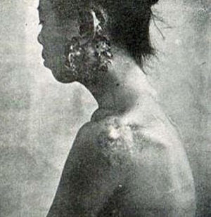 梅毒第3期 ゴム腫 梅毒第3期 ゴム腫